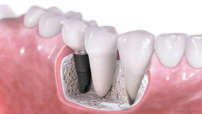 Understanding The Role Of A Periodontist In Dental Implants