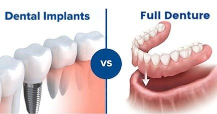 The Cost Comparison Of Dentures Vs. Dental Implants