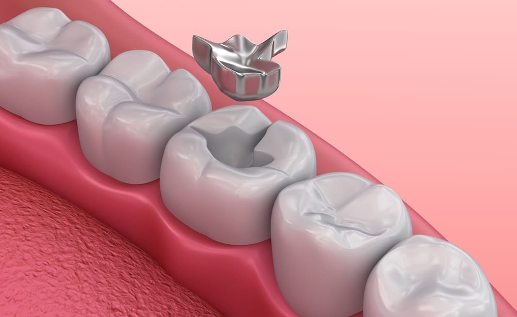 Understanding The Different Types Of Dental Fillings