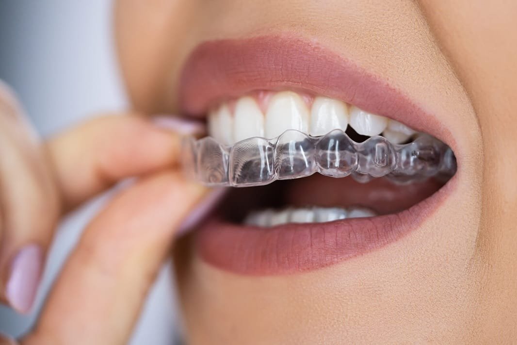 6 Tips For Maintaining Oral Health During Braces Or Aligners