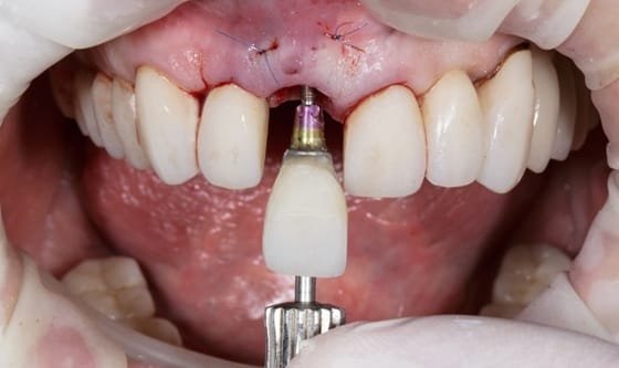 6 Tips For Caring For Gums After Implant Surgery