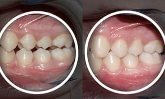 How General Dentistry Detects Bite Alignment Issues Early