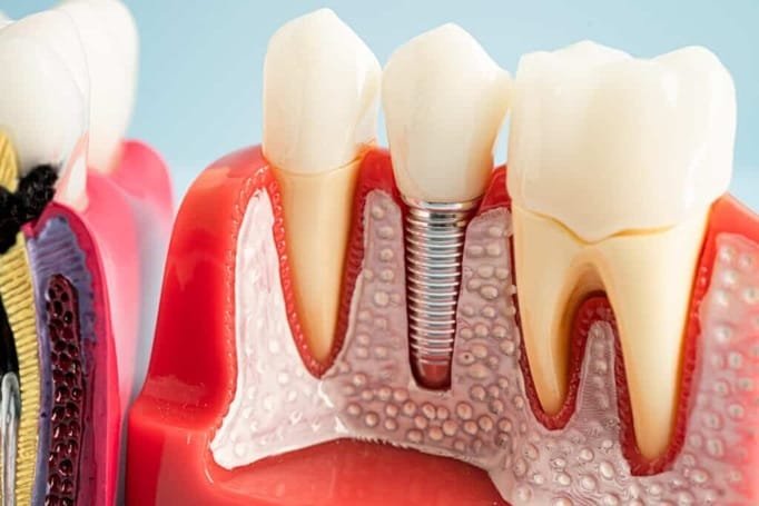 3 Signs You May Need Periodontal Treatment Before Implants