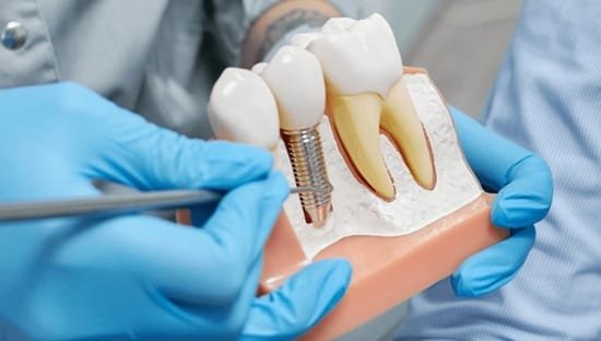 5 Common Myths About Implants In Cosmetic Dentistry Debunked